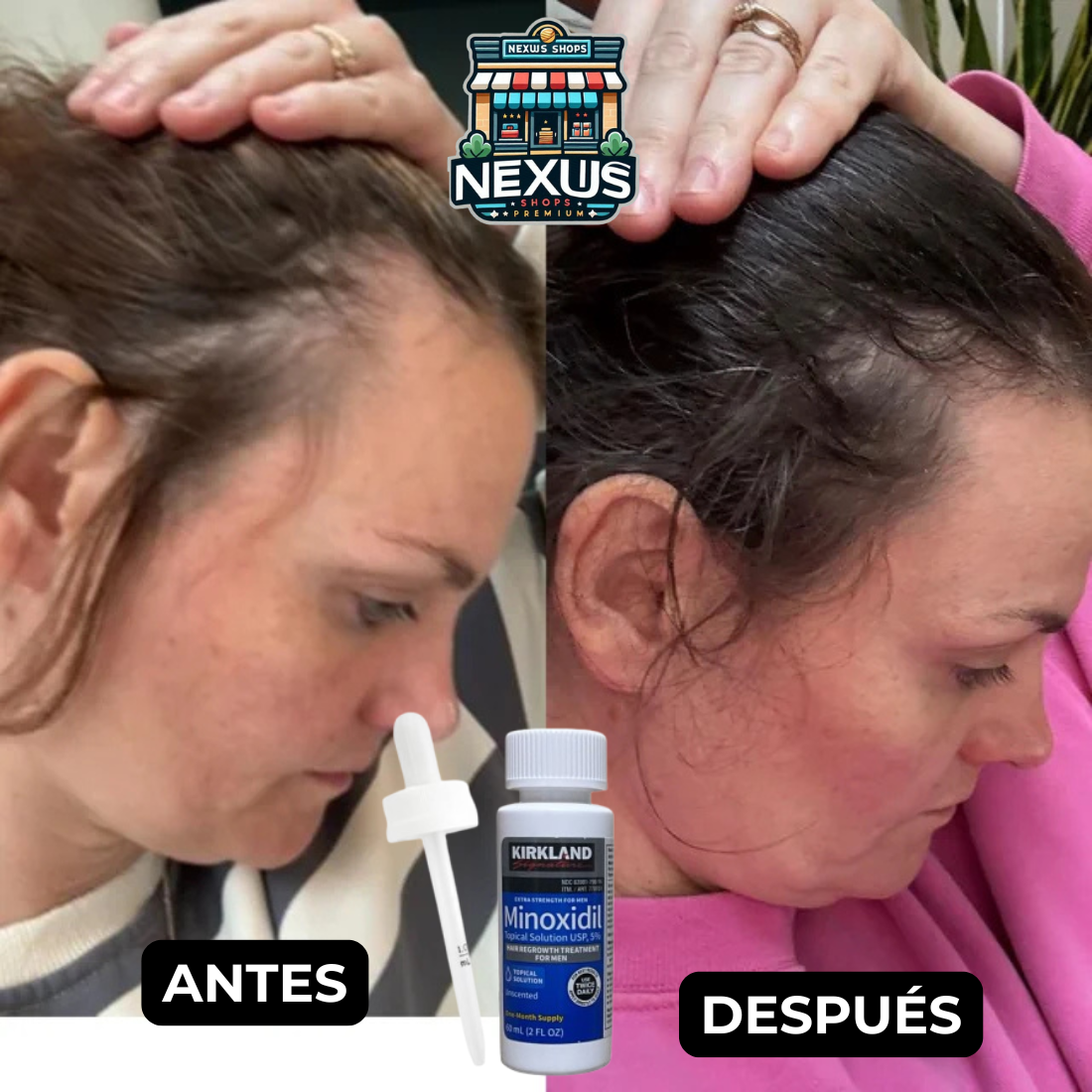 Minoxidil 5%™ ORIGINAL